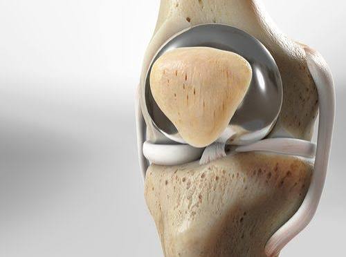 Reemplazo Patelofemoral